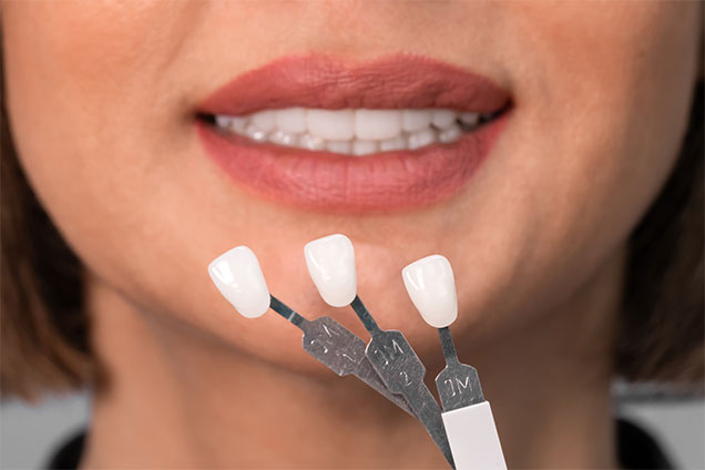 Who Are Candidates for Cerinate™ Veneers at Downtown Dental Associates of Florence